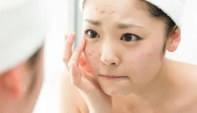 Benzoyl Peroxide là gì? Những thông tin về "khắc tinh" của mụn mà nàng nên biết