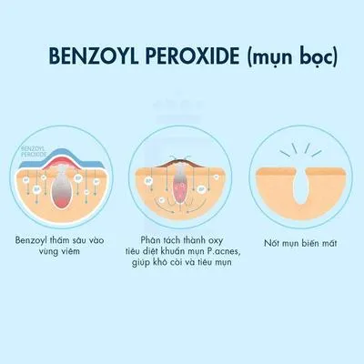 Benzoyl Peroxide là gì? Những thông tin về "khắc tinh" của mụn mà nàng nên biết