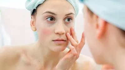 Benzoyl Peroxide là gì? Những thông tin về "khắc tinh" của mụn mà nàng nên biết