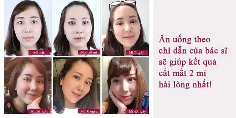 Cắt mí có được ăn trứng không? Lỡ ăn có sao không?