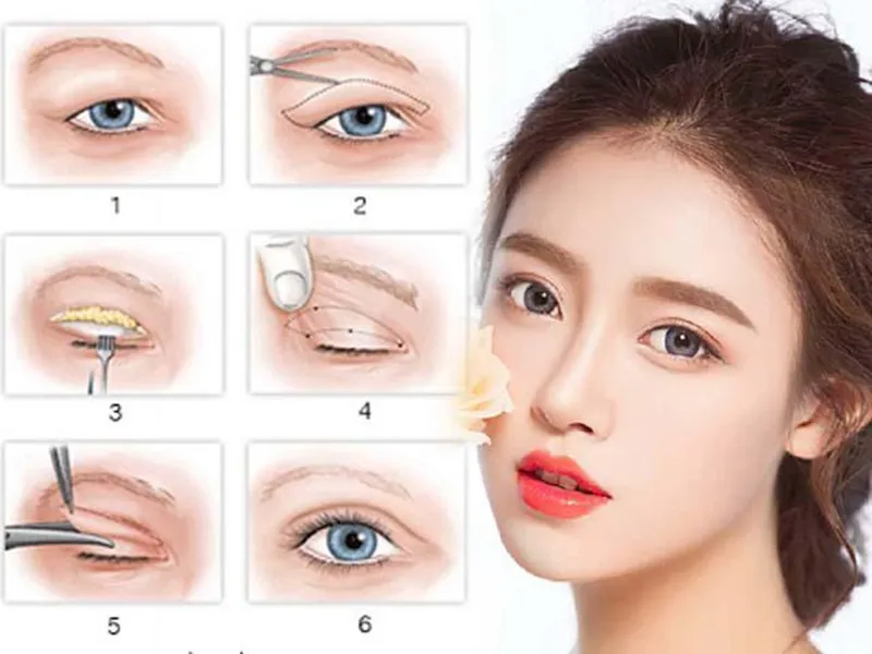 Cắt mí eye lift -phương pháp giúp bạn sở hữu đôi mắt hoàn hảo