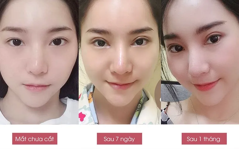 Cắt mí eye lift -phương pháp giúp bạn sở hữu đôi mắt hoàn hảo