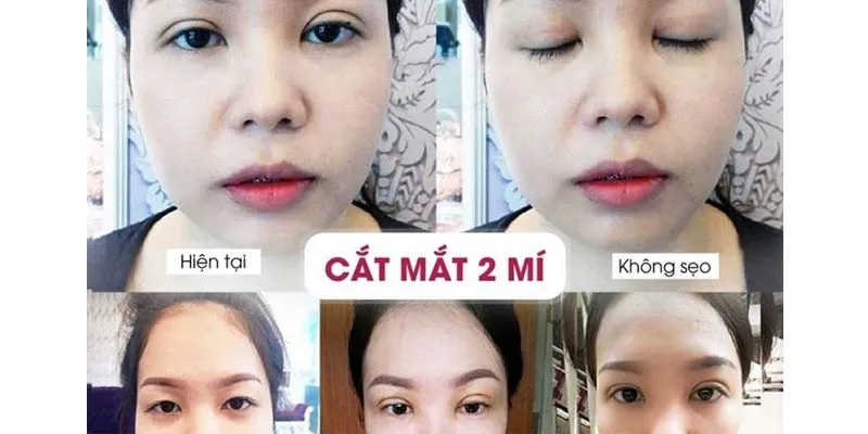 Góc thắc mắc: Cắt mí có ăn được cà muối không?