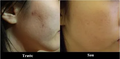 Hãy đọc ngay bài viết nếu bạn đang phân vân có nên xóa thâm mụn bằng laser