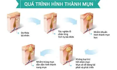 Kem trị mụn trắng da liệu có hiệu quả như lời đồn?