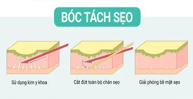 Mặt bị rỗ có chữa được không? Câu trả lời nằm ngay trong bài viết