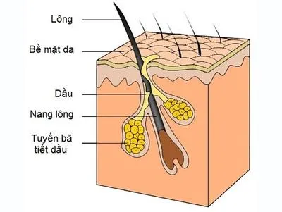 Mụn nấm men – loại mụn rất dễ gây nhầm lẫn và bám riết lấy bạn dai dẳng