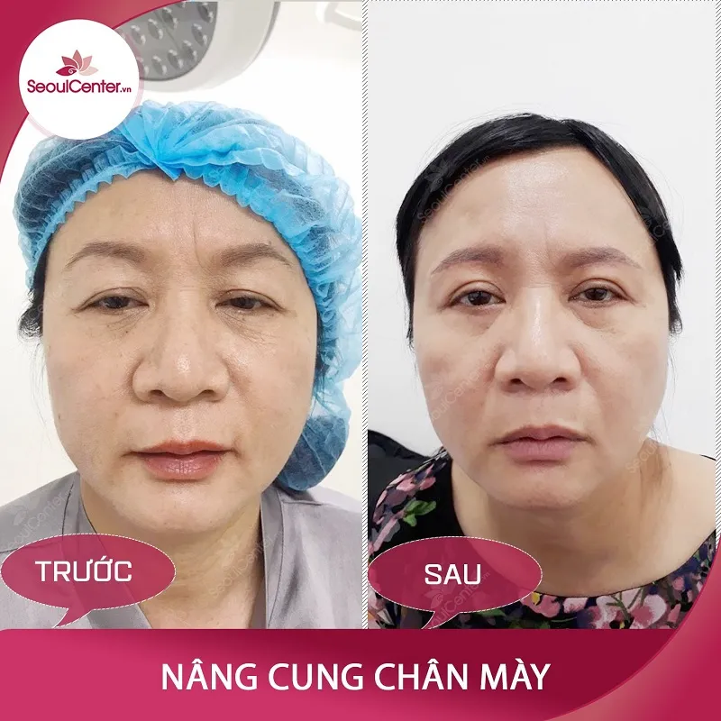 Nâng cung chân mày giá bao nhiêu? Địa điểm an toàn, uy tín