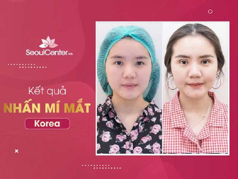 Nhấn mí và cắt mí khác nhau thế nào? So sánh chi tiết