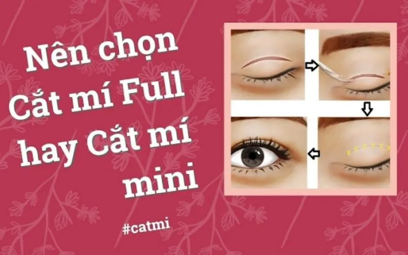 Phân biệt cắt mí mini và cắt mí full – Nên lựa chọn kỹ thuật nào?