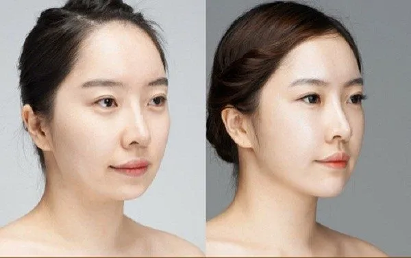 Tiêm filler cằm giá bao nhiêu tiền? Địa chỉ tiêm uy tín tphcm