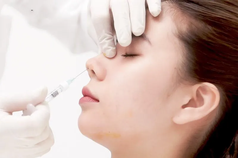 Tiêm filler mũi được bao lâu? Bạn cần biết những gì về nó?