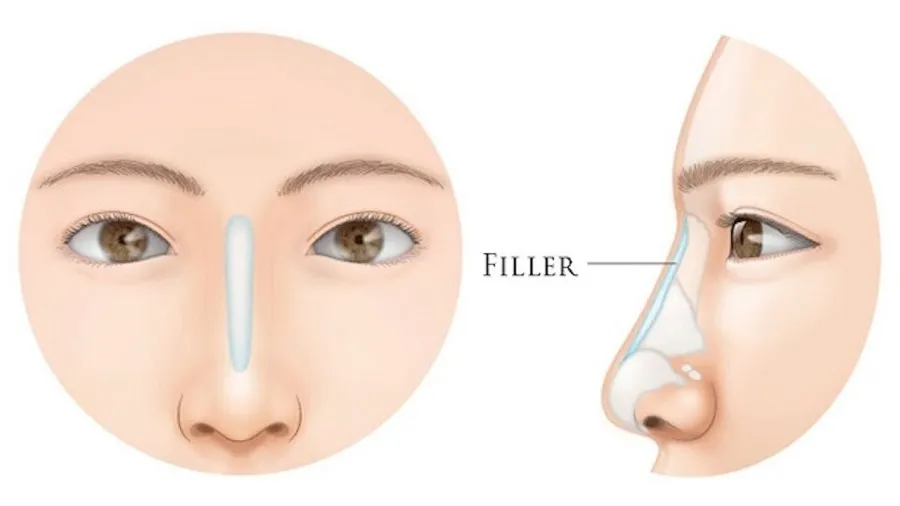 Tiêm filler mũi – Những điều cần biết để có dáng mũi đẹp