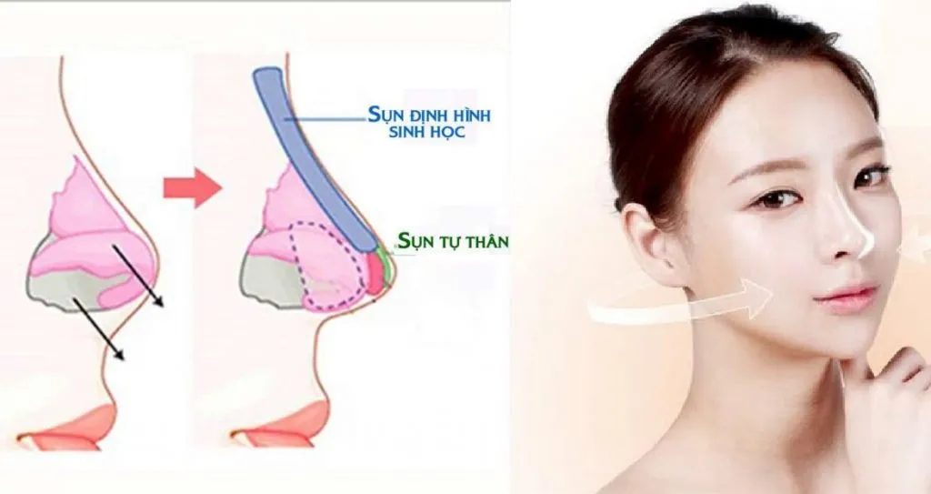 Tìm hiểu về phương pháp nâng mũi bọc sụn