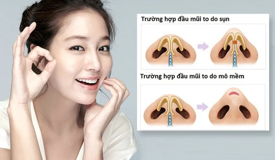 Top 3 cách thu nhỏ đầu mũi an toàn tại nhà không nên bỏ qua