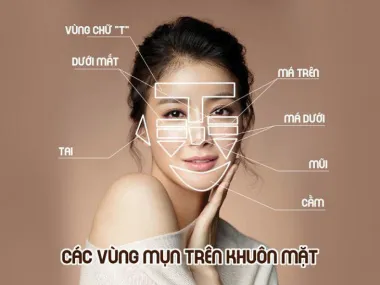 Vị trí mụn tiết lộ vấn đề sức khỏe bạn đang gặp phải